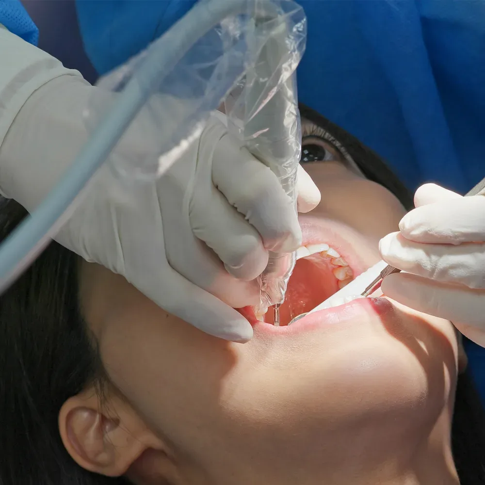 Root Canals at South Anchorage Dental Center