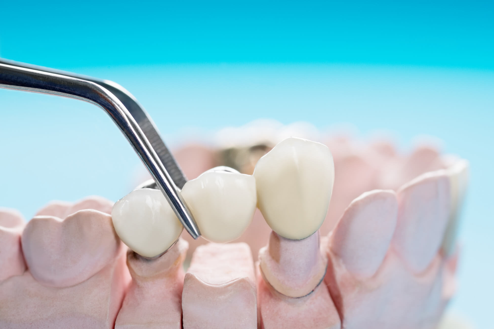 Dental bridges at South Anchorage Dental Center