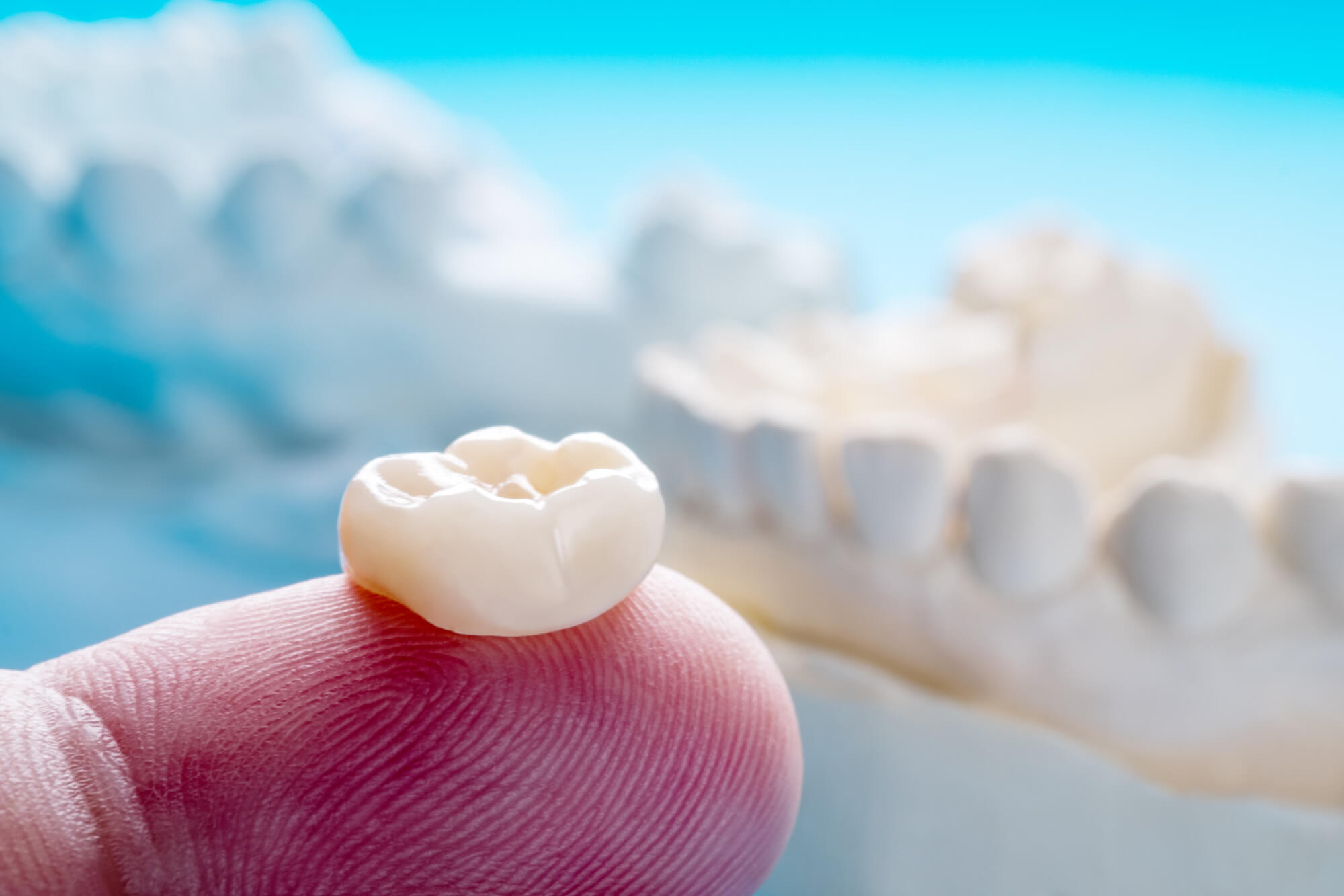 Same day dental crowns at South Anchorage Dental Center